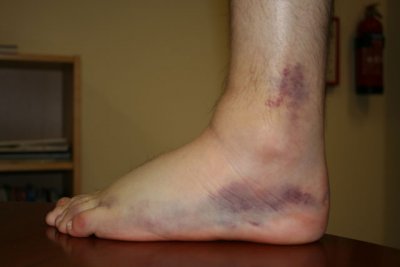 Very bruised left ankle